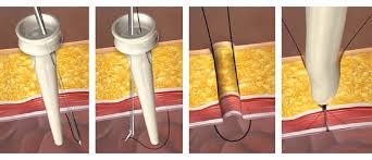 Ct Closesure Port Closure Endotherapeutics