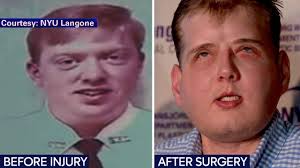 Firefighter opens up 1 year after life-changing face transplant