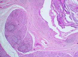 Image result for Sialolithiasis