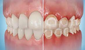 Clean each tooth from top to bottom. What Happens If You Have Braces And Do Not Brush Your Teeth Vaughan Orthodontics