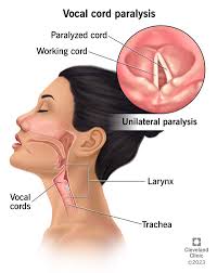Image result for Vocal Cord Dysfunction