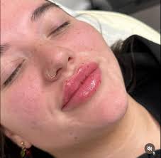 LAST MINUTE APPOINTMENT SLOT⬇️ 1.1ml LIP FILLER Any Technique!💉 TOMORROW,  Tuesday 17th at 1:15pm!💋 Discounted to £65, RRP £120!💫 Message me to  claim, this is offered