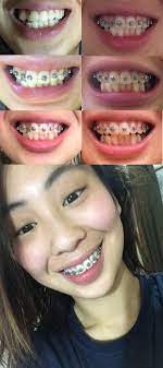 How to get braces for free reddit. Teeth Shifted After Braces Reddit Teethwalls