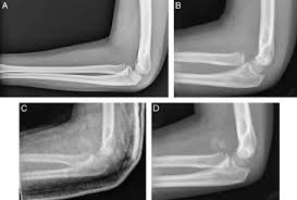 Image result for Radial Head Dislocation