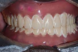 Thus, one can see that the nhs dental charges may cover the most basic of dental crowns. Private Dentures In Manchester City Centre Vallance Dental Centre The Vallance Dental Centre