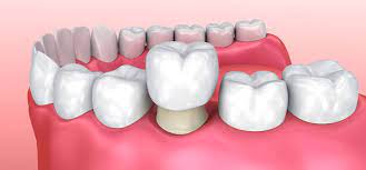 Sehingga pemakai bisa leluasa melepaskan gigi kapan saja untuk membersihkan kotoran pada gigi. Daftar Harga Crown Gigi Beserta Jenis Terbaiknya Fdc Dental Clinic