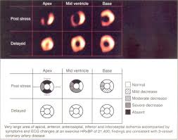 A stress test is used to make sure the heart muscles are able to get enough blood when the heart rate and workload are increased. Cardiovascular Stress Testing A Description Of The Various Types Of Stress Tests And Indications For Their Use Sciencedirect