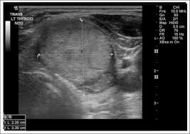 Symptoms of hyperthyroidism (weight loss, heart palpitations, sweating, nervousness, heat intolerance) if you have a thyroid nodule and you are younger than 20 years old or if you have a thyroid nodule and you are older than 70 let me be clear, though, just having these symptoms does not guarantee that you have thyroid cancer. Vanishing Papillary Thyroid Carcinoma Morphological Changes After Fine Needle Aspiration Aace Clinical Case Reports