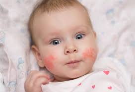 They are due to the development of abnormal cells that have the ability to invade or spread to other parts of the body. Sunburn In Babies Signs Treatment And Prevention