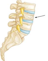 A diagram of a typical nationwide network backbone. Osteoporosis And Spinal Fractures Orthoinfo Aaos