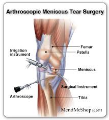 Mendmyknee Com Surgical Meniscus Injury Treatments Meniscus Surgery Knee Surgery Recovery Acl Surgery