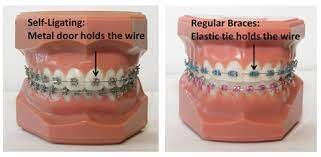 Self Ligating Braces West Valley City Salt Lake Ut Granger Orthodontics