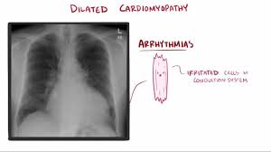 Image result for Cardiomyopathy