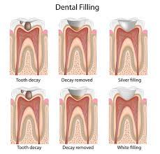 How long does it take to have a cavity filled. Dental Filling Procedure