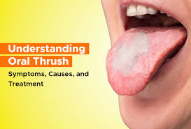 Image result for oral thrush symptoms roof of the mouth