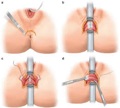 Image result for Fecal Incontinence