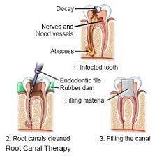 Root Canal In Children What You Need To Know