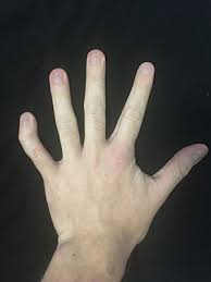 Various men have been spotted walking around with a single fingernail painted on just one hand. Clinodactyly Wikipedia