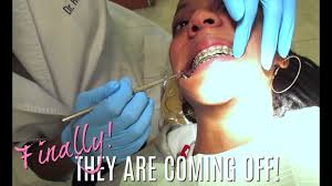 Insurance claims vary significantly in the time it takes to complete the process. Finally Getting My Braces Taken Off The Step By Step Process Youtube