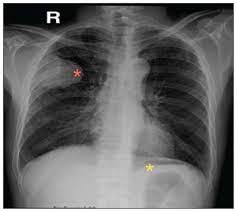 Pleural thickening is a disease that can be caused by asbestos exposure. Metastatic Malignant Pleural Mesothelioma Masquerading As A Case Of Acute Abdomen Secondary To Small Bowel Perforation Annals Of Saudi Medicine