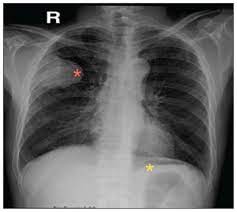 Mesothelioma, is a rare cancer of the membrane that covers the lungs and chest cavity (pleura), the membrane lining the abdominal cavity (peritoneum), or membranes surrounding other internal organs. Metastatic Malignant Pleural Mesothelioma Masquerading As A Case Of Acute Abdomen Secondary To Small Bowel Perforation Annals Of Saudi Medicine