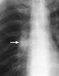 Image result for Broncholithiasis