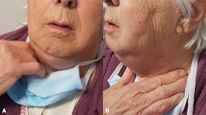 Image result for Jaw Claudication