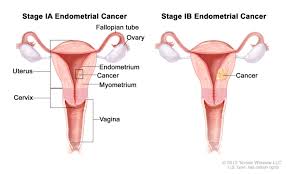 Until then, you might try to: Endometrial Cancer Hematology Oncology Associates Of Cny