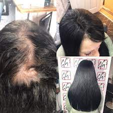 Women S Hair Loss Replacement System Mesh Integration Female Pattern Baldness Mens Hair Extensions Hair Replacement