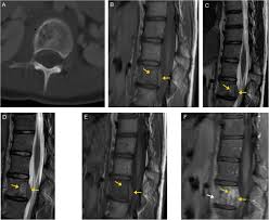 Jay robinson is the backbone of 4marketing perry padina is the backbone of fcc paragon. Bone Up On Spinal Osseous Lesions A Case Review Series Insights Into Imaging Full Text