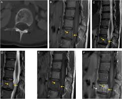 Striking architecture & inspiring urban fabric 3rd december 2019. Bone Up On Spinal Osseous Lesions A Case Review Series Insights Into Imaging Full Text