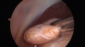 Read about symptoms, recovery, diagnosis, and surgery. Loose Body Removal Cincinnati Arthroscopy West Chester Oh