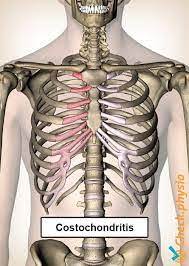 Costochondritis symptoms can be similar to the chest pain associated with a heart attack. Costochondritis Chiropractor Nyc East Village Gramercy Park