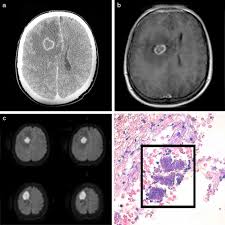 Ivan balicevic boras calle bailarín josé espadero 10/portal 1/3ºa, 03015 alicante tfn.: Absceso Cerebral Actinomicotico En Paciente Inmunocompetente Sciencedirect