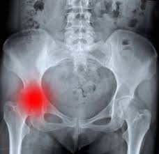 Coxarthrose Symptome Behandlung Der Huftarthrose