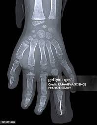 Image result for Hand Growth Plates