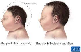 Microcephaly Guillain Barre Syndrome Zika Virus A Guide Library Guides At Tulane University