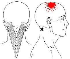 ● myalgie nom féminin douleur musculaire. Splenius Capitis Myalgie Triggerpunkt Und Schmerzmuster