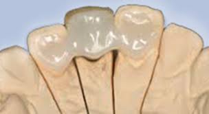 This type of bridge is not as common as the traditional bridge, and it is not recommended for the back of the mouth where. Dental Bridge Restorative Specialist Center With Ceramics Pfm Bridge