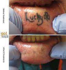Lucky This Tattoo Only Took 5 Treatments To Be Removed Luck Ran Out For This Tattoo Leave Your Witty Lucky Comment Below Inner Lip Tattoos Usually Dovme