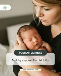 Red, itchy hives shouldn't be one of the surprises welcoming your journey  into motherhood. Postpartum hives are real, and you're not alone in  experiencing them. They are often triggered by hormonal changes,