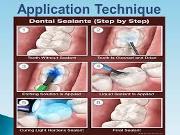 Check spelling or type a new query. Sealants Orozen Dental Clinics