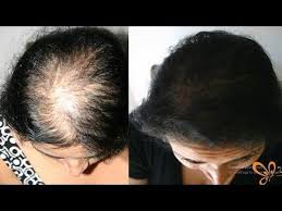 Magic Hair Oil For Fast Hair Growth 15 Days Hair Fall Challenge Stop Hair Loss Home Remedy Youtube Reverse Hair Loss Stop Hair Loss Hair Falling Out