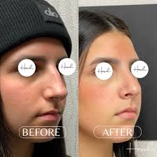 Just 1 month post-op Minimally Invasive Surgical Rhinoplasty by Dr. Hosch &  the results are already breathtaking! Subtle changes, big impact!! 🤩  #newyorkplasticsurgeon #longislandplasticsurgery #medspanyc  #medspalongisland #rhinoplasty ...