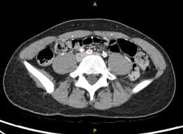 Cureus Symptomatic May Thurner Syndrome Without Deep Venous Thrombosis