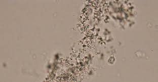 Urine Contains Many Dissolved Substances Solutes That The Body Needs To Eliminate As Waste Chemicals These Solutes Can Form Types Of Crystals Crystals Urinal