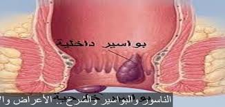 المتفجرات الحجم النسبي عيد الشكر الناسور عند الرجال dsvdedommel com