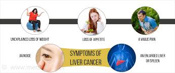 Liver Cancer Types Causes Symptoms Diagnosis Treatment