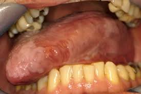 Image result for Erythroplakia roof of mouth