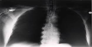 Image result for Open Pneumothorax